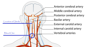 Click to enlarge - Location of blood clot and stroke